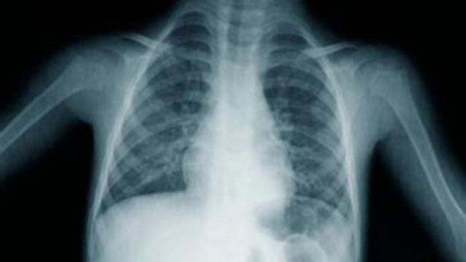 radon uranium nj ny ct pa lung cancer